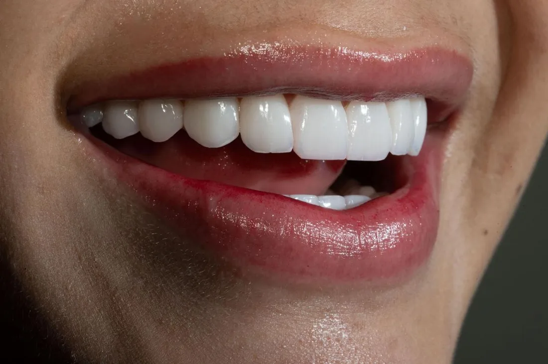 Resultado de diseño de sonrisa en Smiluxe Clinic 1