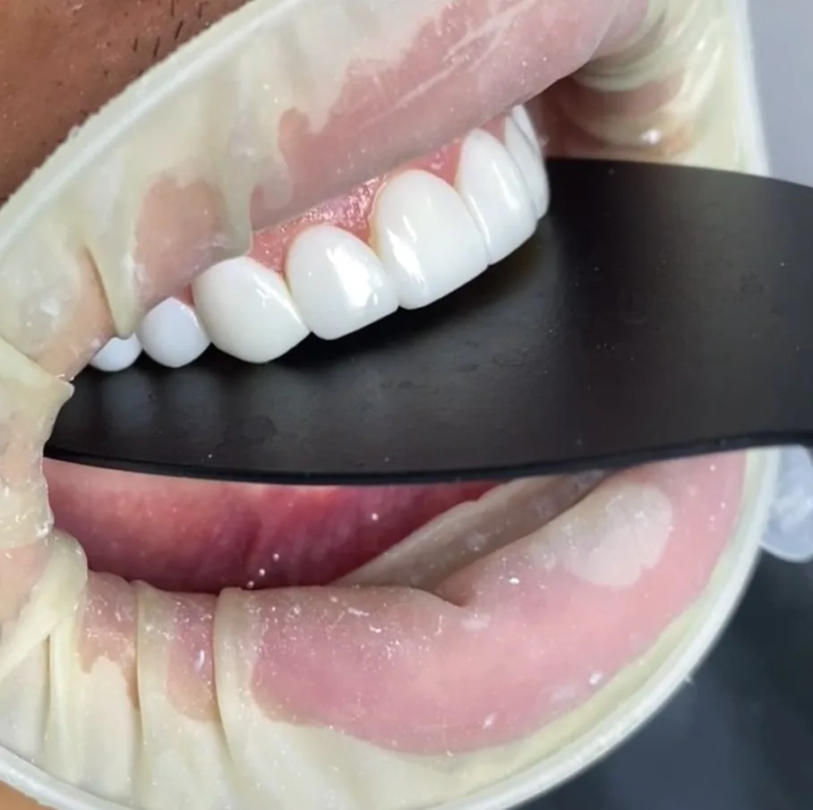Resultado de diseño de sonrisa en Smiluxe Clinic 4