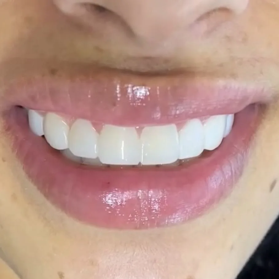 Resultado de diseño de sonrisa en Smiluxe Clinic 7