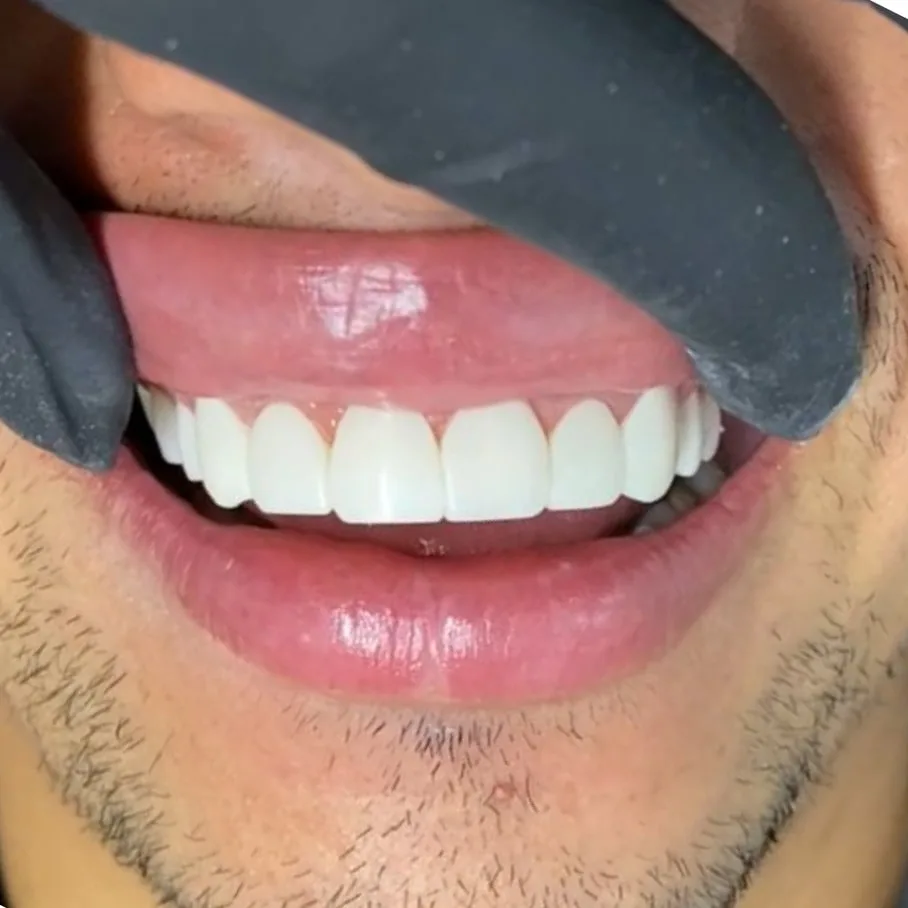 Resultado de diseño de sonrisa en Smiluxe Clinic 6