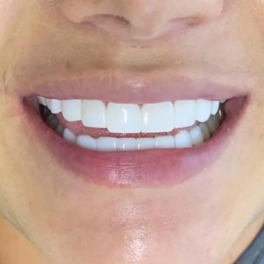 Resultado de diseño de sonrisa en Smiluxe Clinic 5