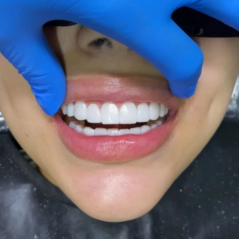 Resultado de diseño de sonrisa en Smiluxe Clinic 2
